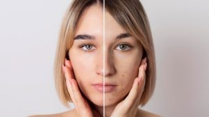 Manchas en la cara: Cómo prevenirlas y revertirlas